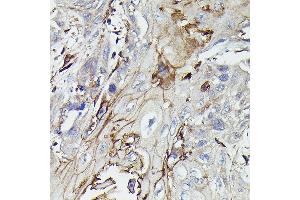 Immunohistochemistry of paraffin-embedded human esophageal cancer using PDGFRB Rabbit pAb (ABIN6134579, ABIN6145372 and ABIN7101437) at dilution of 1:100 (40x lens).