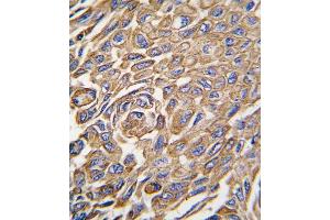 Formalin-fixed and paraffin-embedded human lung carcinoma tissue reacted with ALDH3A1 antibody (Center), which was peroxidase-conjugated to the secondary antibody, followed by DAB staining. (ALDH3A1 Antikörper  (AA 254-284))