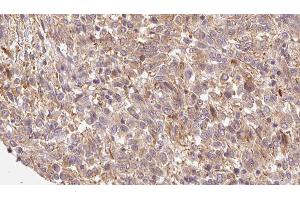 ABIN6279790 at 1/100 staining Human Melanoma tissue by IHC-P. (FRZB Antikörper  (C-Term))