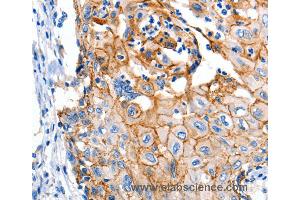 Immunohistochemistry of Human cervical cancer using CLDN1 Polyclonal Antibody at dilution of 1:150 (Claudin 1 Antikörper)