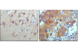 Immunohistochemical analysis of paraffin-embedded human cerebra (left) and breast carcinoma tissue (right),showing cytoplasmic and membrane location with DAB staining using ERBB3 antibody.