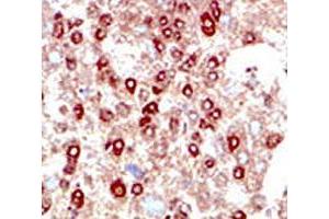 IHC testing of human hepatocarcinoma stained with SUMO2/3 antibody. (SUMO2/3 Antikörper  (AA 49-81))