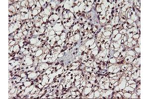 Immunohistochemical staining of paraffin-embedded Carcinoma of Human kidney tissue using anti-MGLL mouse monoclonal antibody. (MGLL Antikörper)