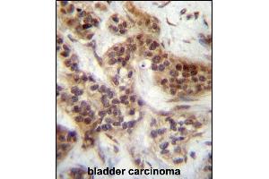 FOXA2 Antibody (Center ) (ABIN657130 and ABIN2846274) immunohistochemistry analysis in formalin fixed and paraffin embedded human bladder carcinoma followed by peroxidase conjugation of the secondary antibody and DAB staining.