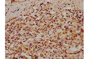 IHC image of ABIN7150293 diluted at 1:300 and staining in paraffin-embedded human lung cancer performed on a Leica BondTM system.