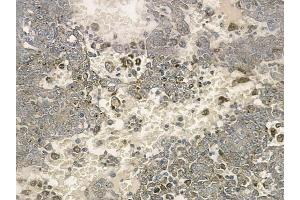 ABIN6259198 and ABIN6274317 at 1/100 staining human melanoma by IHC-P. (SSBP1 Antikörper  (Internal Region))