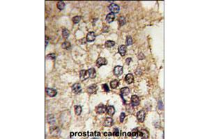 Formalin-fixed and paraffin-embedded human prostate carcinoma tissue reacted with CLOCK polyclonal antibody  , which was peroxidase-conjugated to the secondary antibody, followed by DAB staining. (CLOCK Antikörper  (Internal Region))