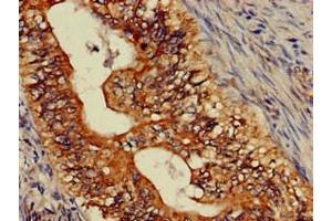 Immunohistochemistry of paraffin-embedded human colon cancer using ABIN7144771 at dilution of 1:100 (Astrotactin 2 Antikörper  (AA 108-272))