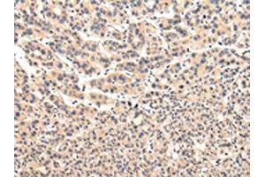The image on the left is immunohistochemistry of paraffin-embedded Human liver cancer tissue using ABIN7131583(VPS37A Antibody) at dilution 1/20, on the right is treated with fusion protein. (VPS37A Antikörper)
