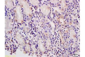 Formalin-fixed and paraffin embedded human gastric carcinoma tissue labeled with Anti-PAF Polyclonal Antibody, Unconjugated (ABIN737931) at 1:200 followed by conjugation to the secondary antibody and DAB staining (KIAA0101 Antikörper)