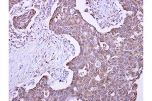IHC-P Image Malectin antibody detects KIAA0152 protein at cytosol on human colon carcinoma by immunohistochemical analysis. (Malectin Antikörper)