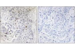Immunohistochemistry analysis of paraffin-embedded human breast carcinoma tissue, using MAFF Antibody. (MafF Antikörper  (AA 51-100))