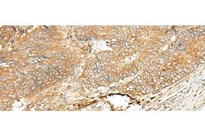 Immunohistochemistry of paraffin-embedded Human colorectal cancer tissue using ADGRF5 Polyclonal Antibody at dilution of 1:40(x200) (G Protein-Coupled Receptor 116 Antikörper)