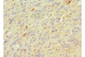 Immunohistochemistry of paraffin-embedded human melanoma using ABIN7154393 at dilution of 1:100 (Granulin Antikörper  (AA 20-310))