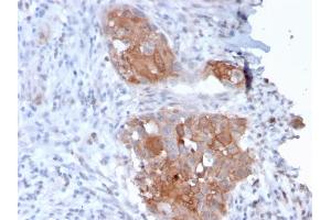 Formalin-fixed, paraffin-embedded human Bladder Carcinoma stained with Desmoglein-1 Mouse Monoclonal Antibody (32-2B). (Desmoglein 1 Antikörper)