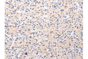 The image on the left is immunohistochemistry of paraffin-embedded Human liver cancer tissue using ABIN7190022(BSN Antibody) at dilution 1/20, on the right is treated with synthetic peptide. (Bassoon Antikörper)