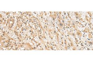 Immunohistochemistry of paraffin-embedded Human liver cancer tissue using NUDT12 Polyclonal Antibody at dilution of 1:25(x200) (NUDT12 Antikörper)