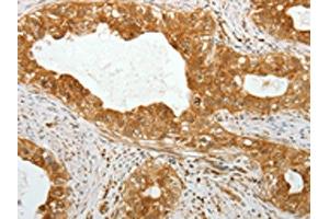 The image on the left is immunohistochemistry of paraffin-embedded Human cervical cancer tissue using ABIN7131317(TEKT1 Antibody) at dilution 1/30, on the right is treated with fusion protein. (TEKT1 Antikörper)