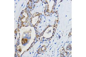 Immunohistochemistry of paraffin-embedded Human thyroid cancer using CYP51 Rabbit pAb (3485) at dilution of 1:50 (40x lens). (CYP51A1 Antikörper  (AA 210-509))