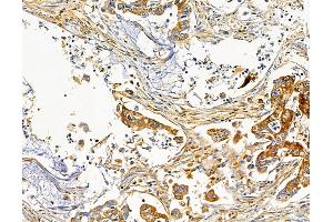 ABIN7095732 and ABIN7099794 at 1/100 staining human pancreatic cancer by IHC-P. (KCNIP2 Antikörper)