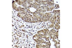 Immunohistochemistry of paraffin-embedded human colon carcinoma using [KO Validated] ST Rabbit mAb (ABIN7270305) at dilution of 1:100 (40x lens). (STAT3 Antikörper)