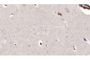 ABIN6272927 at 1/100 staining Human brain cancer tissue by IHC-P. (PIEZO1 Antikörper  (Internal Region))