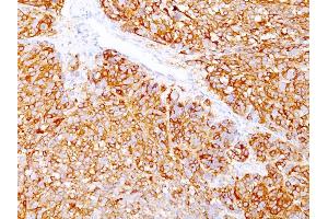 Formalin-fixed, paraffin-embedded human Melanoma stained with Melanoma Marker Mouse Monoclonal Antibody (DT101+ BC199 + HMB45). (MLANA & SILV Antikörper)