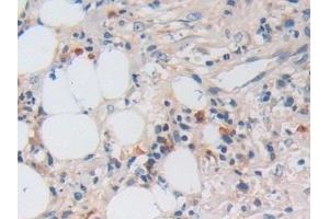 Detection of NB1 in Human Skin cancer Tissue using Polyclonal Antibody to Neutrophil Specific Antigen 1 (NB1) (CD177 Antikörper  (AA 133-301))