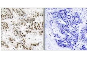 Immunohistochemical analysis of paraffin-embedded human breast carcinoma tissue using SAPK/JNK (Ab-185) antibody (E021242). (SAPK, JNK Antikörper)