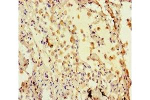 Immunohistochemistry of paraffin-embedded human lung cancer using ABIN7155425 at dilution of 1: 100 (Histone 3 Antikörper  (AA 2-30))