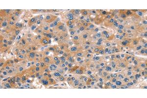 Immunohistochemistry of paraffin-embedded Human liver cancer tissue using ALOX15 Polyclonal Antibody at dilution 1:50 (ALOX15 Antikörper)