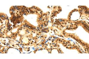 Immunohistochemistry (Paraffin-embedded Sections) (IHC (p)) image for anti-serpin Peptidase Inhibitor, Clade B (Ovalbumin), Member 1 (SERPINB1) antibody (ABIN7000857)