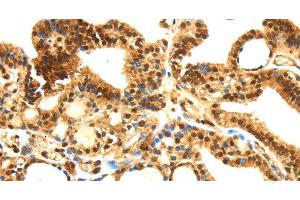 Immunohistochemistry of paraffin-embedded Human thyroid cancer tissue using SERPINB1 Polyclonal Antibody at dilution 1:30