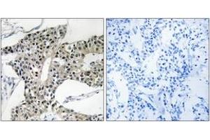 Immunohistochemistry analysis of paraffin-embedded human breast carcinoma tissue, using ARSK Antibody. (Arylsulfatase K Antikörper  (AA 481-530))