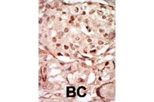 Formalin-fixed and paraffin-embedded human cancer tissue reacted with CDK10 polyclonal antibody , which was peroxidase-conjugated to the secondary antibody, followed by DAB staining.