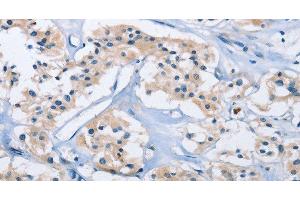Immunohistochemistry of paraffin-embedded Human thyroid cancer using CARD14 Polyclonal Antibody at dilution of 1:30 (CARD14 Antikörper)
