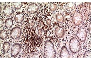 Immunohistochemistry of paraffin-embedded Human colon carcinoma tissue using Epsilon Tubulin Monoclonal Antibody at dilution of 1:200. (TUBE1 Antikörper)