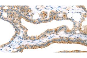 Immunohistochemistry of paraffin-embedded Human thyroid cancer using TNIP2 Polyclonal Antibody at dilution of 1:35 (TNIP2 Antikörper)