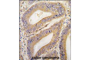 Formalin-fixed and paraffin-embedded human colon carcinoma tissue reacted with PHB2 polyclonal antibody  , which was peroxidase-conjugated to the secondary antibody, followed by DAB staining. (Prohibitin 2 Antikörper  (N-Term))