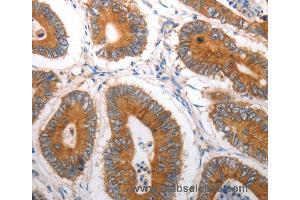 Immunohistochemistry of Human liver cancer using SLC12A6 Polyclonal Antibody at dilution of 1:40 (SLC12A6 Antikörper)
