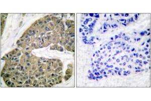 Immunohistochemistry analysis of paraffin-embedded human breast carcinoma tissue, using Keratin 5 Antibody.