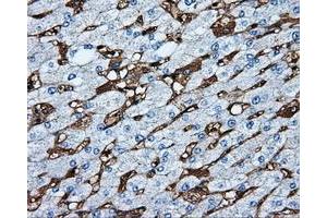 Immunohistochemical staining of paraffin-embedded Carcinoma of liver tissue using anti-MTRF1L mouse monoclonal antibody.