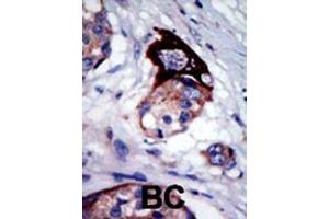 Formalin-fixed and paraffin-embedded human cancer tissue reacted with the primary antibody, which was peroxidase-conjugated to the secondary antibody, followed by AEC staining. (MARK3 Antikörper  (C-Term))