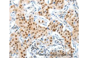 Immunohistochemistry of Human lung cancer using APPL1 Polyclonal Antibody at dilution of 1:70 (APPL1 Antikörper)