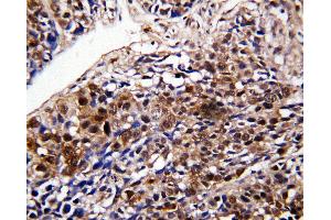 Anti-DDT antibody, IHC(P) IHC(P): Human Lung Cancer Tissue (DDT Antikörper  (C-Term))
