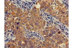 Immunohistochemistry of paraffin-embedded human pancreatic cancer using ABIN7143258 at dilution of 1:100 (AOAH Antikörper  (AA 180-254))