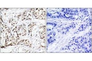 Immunohistochemistry analysis of paraffin-embedded human breast carcinoma, using SAPK/JNK (Phospho-Thr183) Antibody. (SAPK, JNK (AA 151-200), (pThr183) Antikörper)