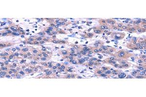 Immunohistochemistry of paraffin-embedded Human liver cancer using TRIM49 Polyclonal Antibody at dilution of 1/40 (TRIM49 Antikörper)