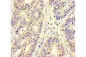 Immunohistochemistry of paraffin-embedded human colon cancer using ABIN7159762 at dilution of 1:100 (MAPRE1 Antikörper  (AA 2-268))