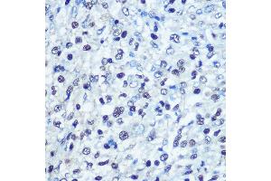 Immunohistochemistry of paraffin-embedded human liver cancer using [KO Validated] S Rabbit pAb (ABIN6132834, ABIN6147368, ABIN6147369 and ABIN7101817) at dilution of 1:100 (40x lens). (SAMHD1 Antikörper  (AA 387-626))